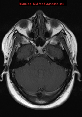 File:Neuroglial cyst (Radiopaedia 10713-11184 Axial T1 17).jpg