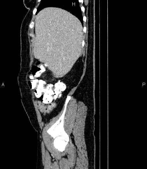 File:Non-Hodgkin lymphoma (Radiopaedia 84008-99238 D 15).jpg