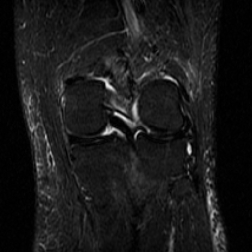File:Non-displaced patella fracture (Radiopaedia 15932-15582 Coronal STIR 16).jpg