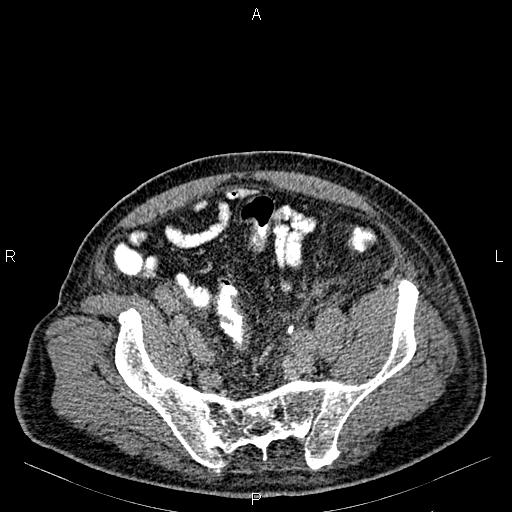 Non Hodgkin lymphoma in a patient with ankylosing spondylitis (Radiopaedia 84323-99621 Axial C+ delayed 62).jpg