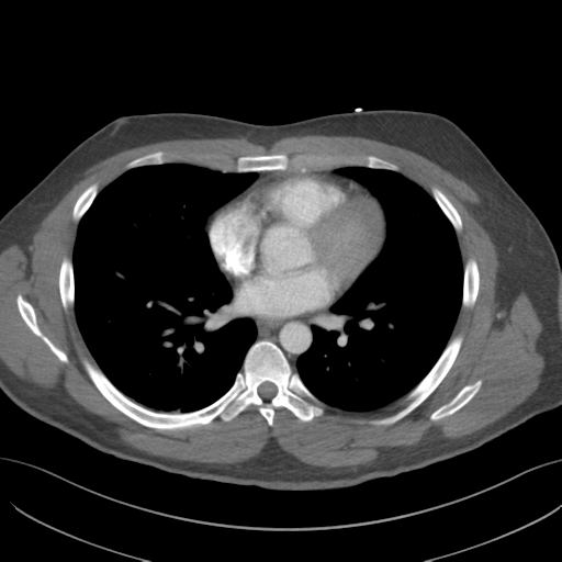 File:Normal CTA thorax (non ECG gated) (Radiopaedia 41750-44704 A 56).png