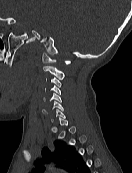 File:Normal CT cervical spine - pediatric (Radiopaedia 52549-58462 Sagittal bone window 165).jpg