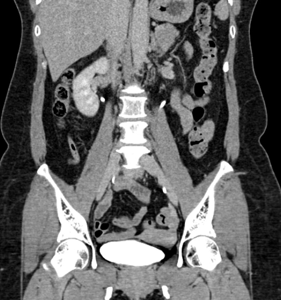 Normal CT intravenous urogram (Radiopaedia 39444-41759 A 275).jpg