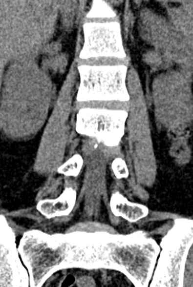 Normal CT lumbar spine (Radiopaedia 53981-60118 F 41).jpg