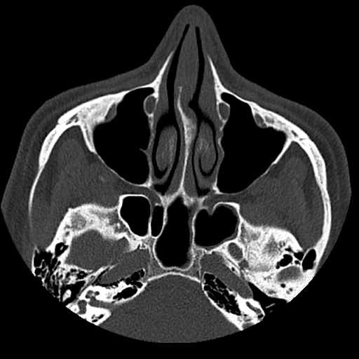 Normal CT paranasal sinuses (Radiopaedia 42286-45390 Axial bone window 67).jpg