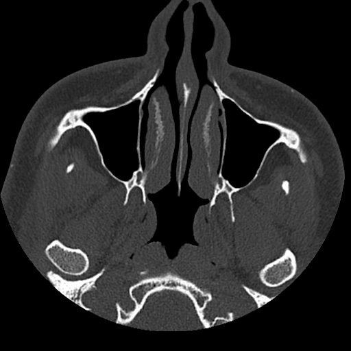 Normal CT paranasal sinuses (Radiopaedia 42286-45390 Axial bone window 83).jpg