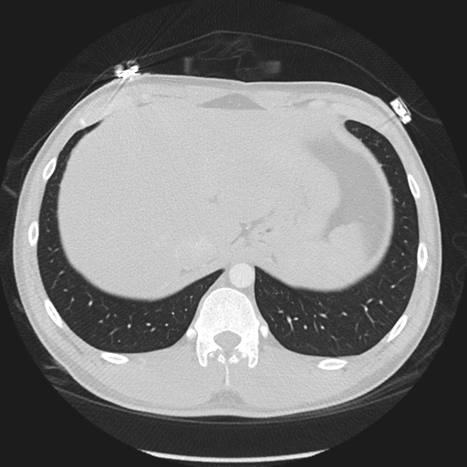 Normal CT pulmonary veins (pre RF ablation) (Radiopaedia 41748-44702 Axial lung window 63).png