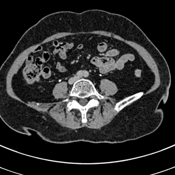 File:Normal CT split bolus study of the renal tract (Radiopaedia 48631-53634 Axial split bolus 168).jpg