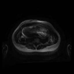 Normal MRI abdomen in pregnancy (Radiopaedia 88001-104541 Axial DWI 105).jpg