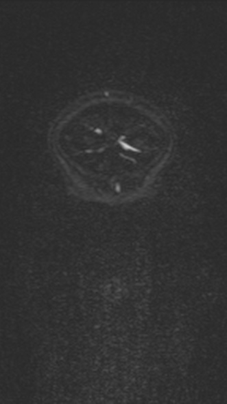 Normal MRI brain with MRV- teenager (Radiopaedia 49425-54553 Coronal MRV 36).jpg