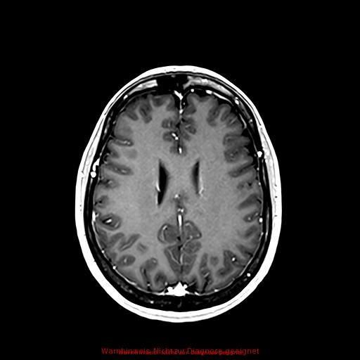 Normal adult brain MRI (non-enhanced and contrast-enhanced) (Radiopaedia 75262-86379 Axial T1 C+ 126).jpg