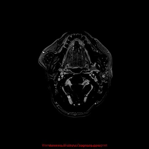 Normal adult brain MRI (non-enhanced and contrast-enhanced) (Radiopaedia 75262-86379 Axial T1 C+ 8).jpg