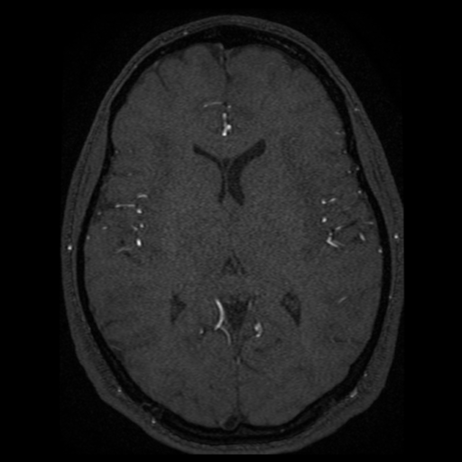 Normal brain MRA (Radiopaedia 41046-43793 Axial MRA 18).png