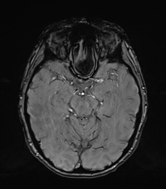 Normal brain MRI (TLE protocol) (Radiopaedia 40748-43405 Axial SWI 34).png