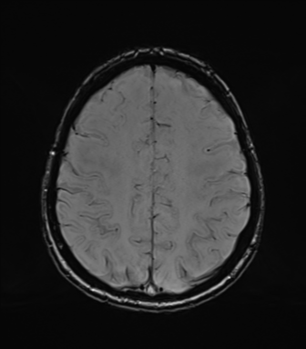 Normal brain MRI (TLE protocol) (Radiopaedia 40748-43405 Axial SWI 64).png