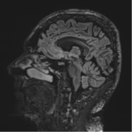 Normal brain MRI (non-focal epilepsy protocol) (Radiopaedia 53917-60040 Sagittal DIR 31).png