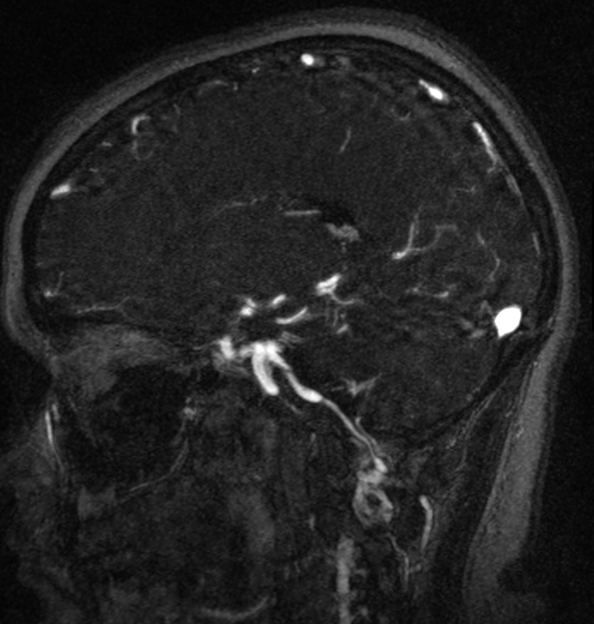 Normal brain MRI and venogram (Radiopaedia 39554-41862 Sagittal MRV 40).jpg