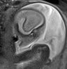 Normal brain fetal MRI - 22 weeks (Radiopaedia 50623-56050 Sagittal T2 Haste 16).jpg