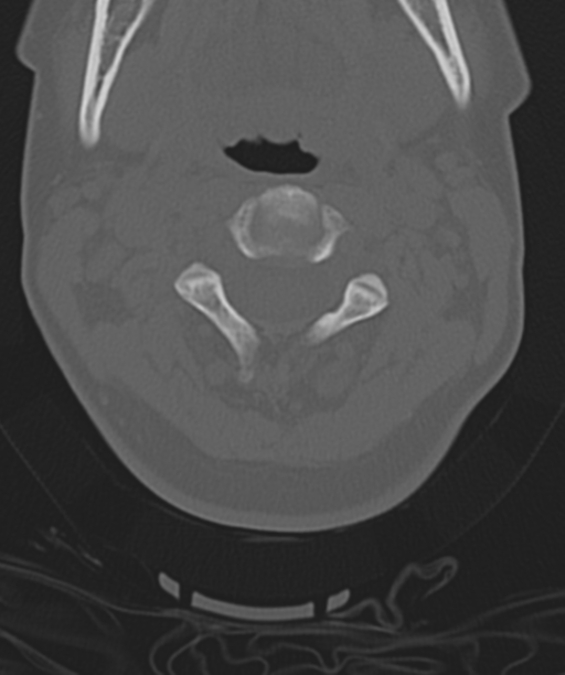 Normal cervical spine MRI (including Dixon) (Radiopaedia 42762-45926 Axial bone window 20).png