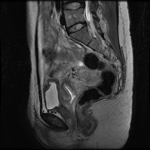 File:Normal female pelvis MRI (retroverted uterus) (Radiopaedia 61832-69933 Sagittal T2 16).jpg