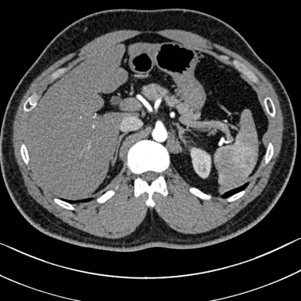 Normal kidneys on 4-phase CT study (Radiopaedia 25889-26038 B 6).jpg