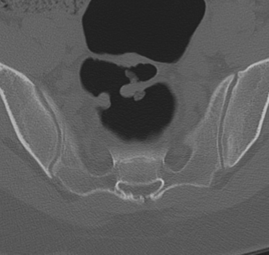 File:Normal lumbosacral CT (Radiopaedia 37923-39867 Axial bone window 93).png