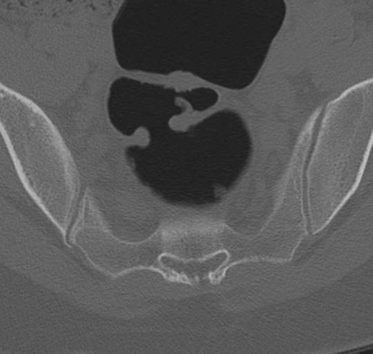 File:Normal lumbosacral CT (Radiopaedia 37923-39867 Axial bone window 94).png