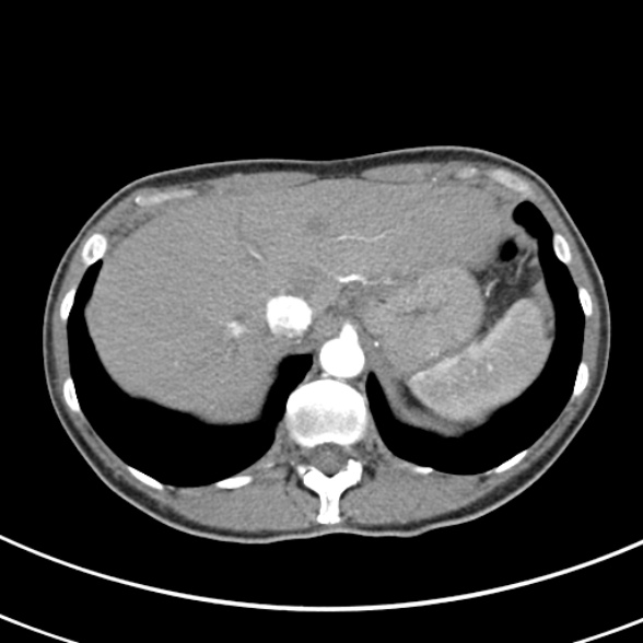 File:Normal multiphase CT liver (Radiopaedia 38026-39996 B 13).jpg