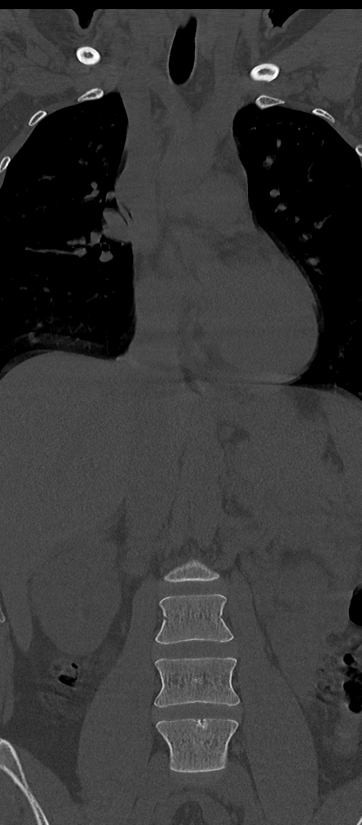 Normal thoracolumbar spine (Radiopaedia 43822-47309 Coronal bone window 28).png