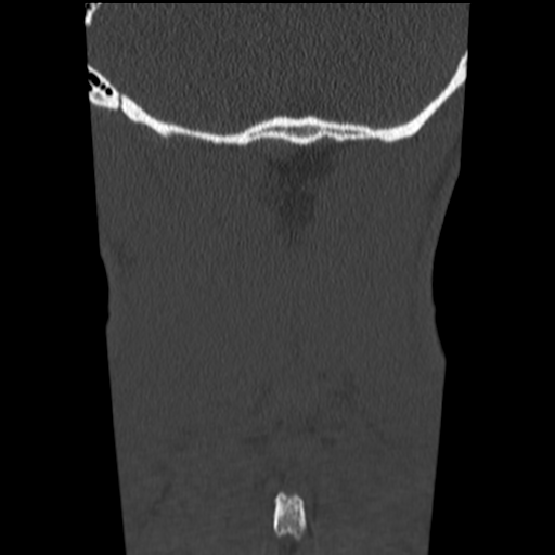 File:Normal trauma cervical spine (Radiopaedia 41017-43760 Coronal bone window 47).png