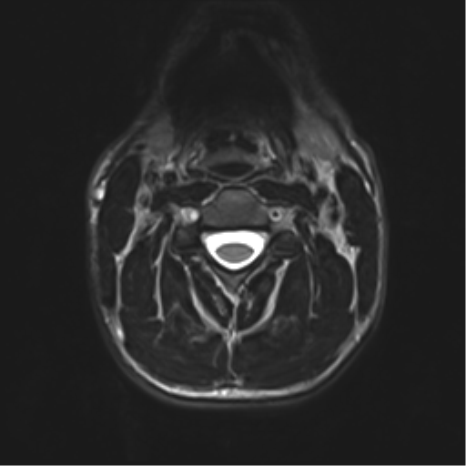 Normal trauma cervical spine (Radiopaedia 41017-43762 D 17).png
