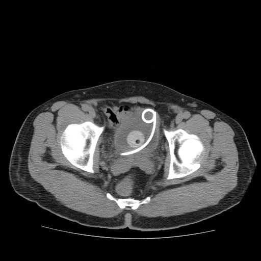 File:Obstructed kidney with perinephric urinoma (Radiopaedia 26889-27067 Axial non-contrast 36).jpg