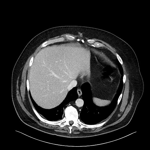 Obstructing sigmoid adenocarcinoma (Radiopaedia 58465-65619 A 25).jpg