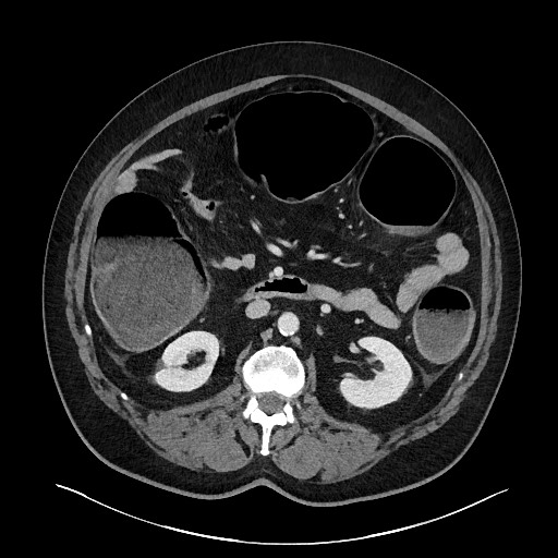 Obstructing sigmoid adenocarcinoma (Radiopaedia 58465-65619 A 72).jpg