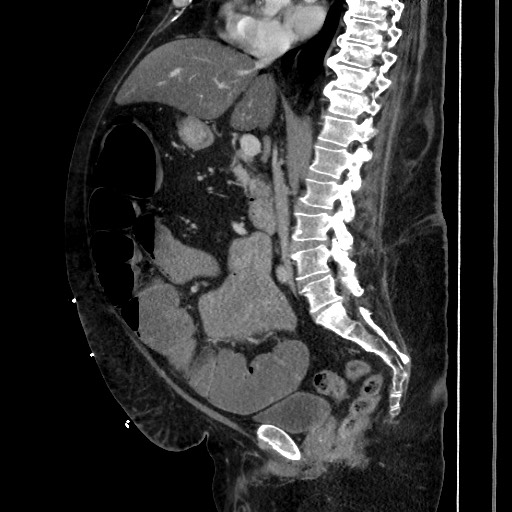 Obstructive colonic diverticular stricture (Radiopaedia 81085-94675 C 118).jpg