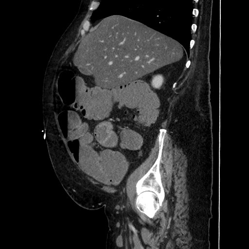 Obstructive colonic diverticular stricture (Radiopaedia 81085-94675 C 76).jpg
