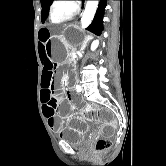 Obturator hernia causing small bowel obstruction (Radiopaedia 65522-74612 C 42).jpg