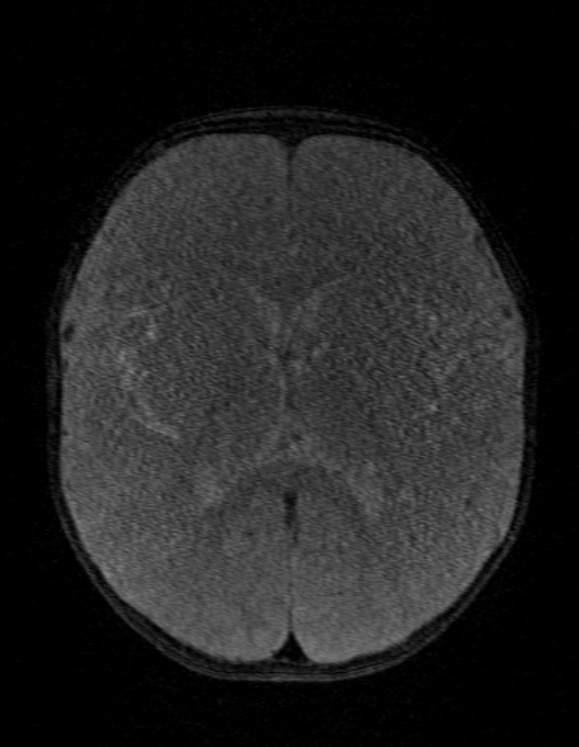 Occipital horn syndrome (Radiopaedia 14255-14129 MRA 89).jpg