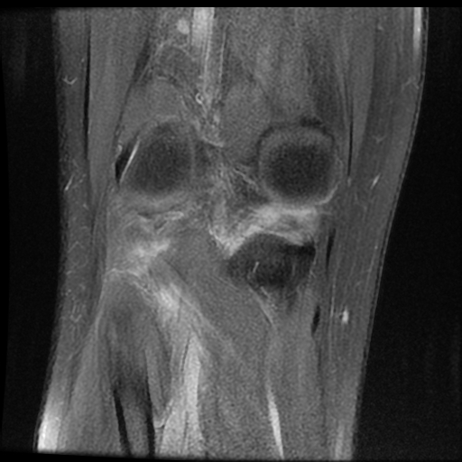 File:ACL acute full thickness tear - deep lateral femoral sulcus sign (Radiopaedia 38594-40740 Coronal PD fat sat 17).jpg