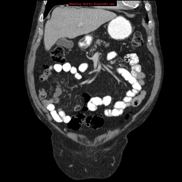 File:Abdominal aortic aneurysm (Radiopaedia 10122-10660 Coronal C+ portal venous phase 1).jpg