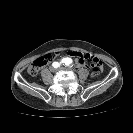 File:Abdominal aortic aneurysm (Radiopaedia 13341-13340 Axial C+ arterial phase 159).jpg