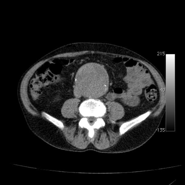 Abdominal aortic aneurysm (Radiopaedia 29248-29660 Axial non-contrast 34).jpg