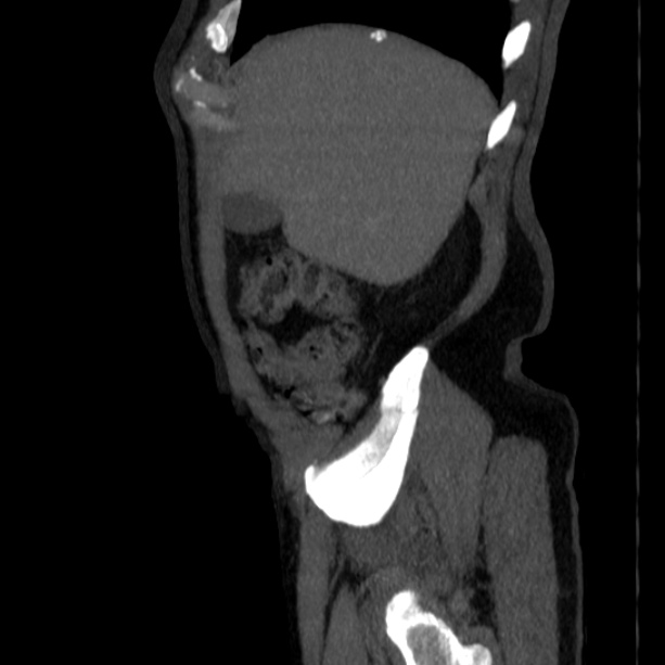 Abdominal aortic aneurysm (Radiopaedia 29248-29660 Sagittal C+ arterial phase 6).jpg