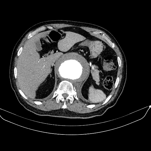 File:Abdominal aortic aneurysm (Radiopaedia 67117-76452 Axial C+ arterial phase 32).jpg