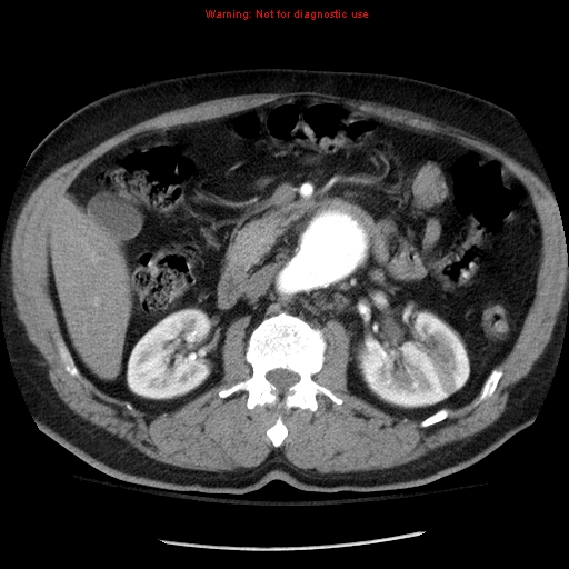 Abdominal aortic aneurysm (Radiopaedia 8190-9038 Axial C+ arterial phase 33).jpg