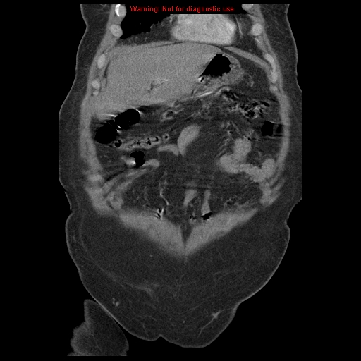 Abdominal aortic aneurysm (Radiopaedia 8190-9038 Coronal C+ arterial phase 24).jpg