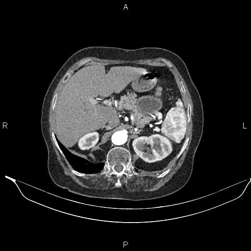 File:Abdominal aortic aneurysm (Radiopaedia 85063-100606 Axial C+ arterial phase 32).jpg