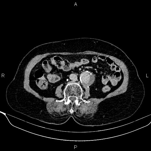 Abdominal aortic aneurysm (Radiopaedia 85063-100606 Axial C+ delayed 64).jpg