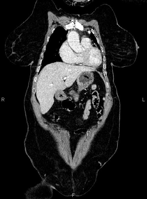 Abdominal aortic aneurysm (Radiopaedia 85063-100606 Coronal C+ arterial phase 9).jpg