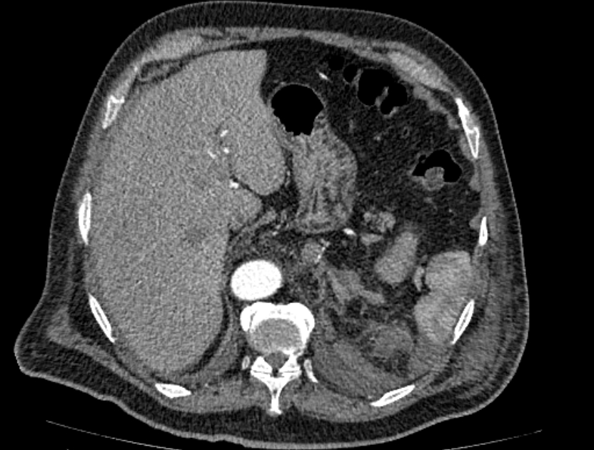 Abdominal aortic aneurysm rupture (Radiopaedia 54179-60362 Axial C+ arterial phase 21).jpg